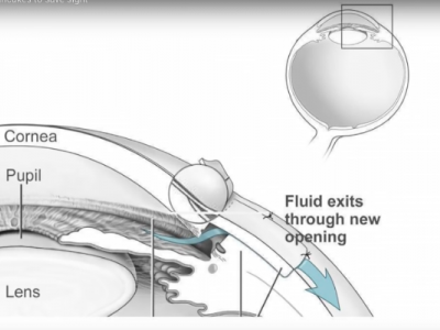 My Research Makespace: Pancake Making for Glaucoma Surgery